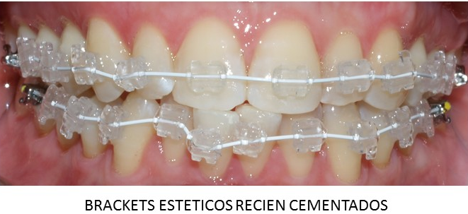 Brackets Estéticos