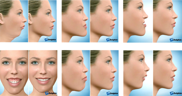 Cirugía ortognatica